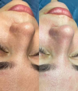 Home 3 antes e depois ucanti branca